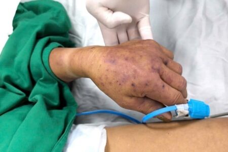 Hà Nội ghi nhận ca đầu tiên tử vong vì mắc liên cầu lợn